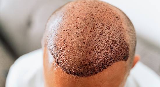 Hair Transplant & Restoration-img